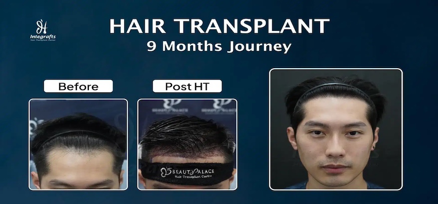 Transplantasi Rambut
